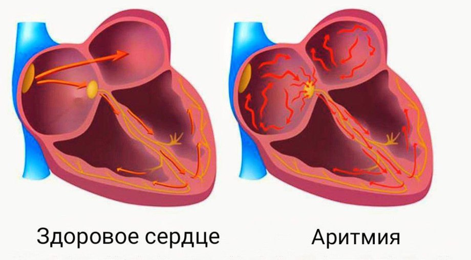 Аритмия – лечение, симптомы и причины аритмии сердца | ФНКЦ ФМБА России